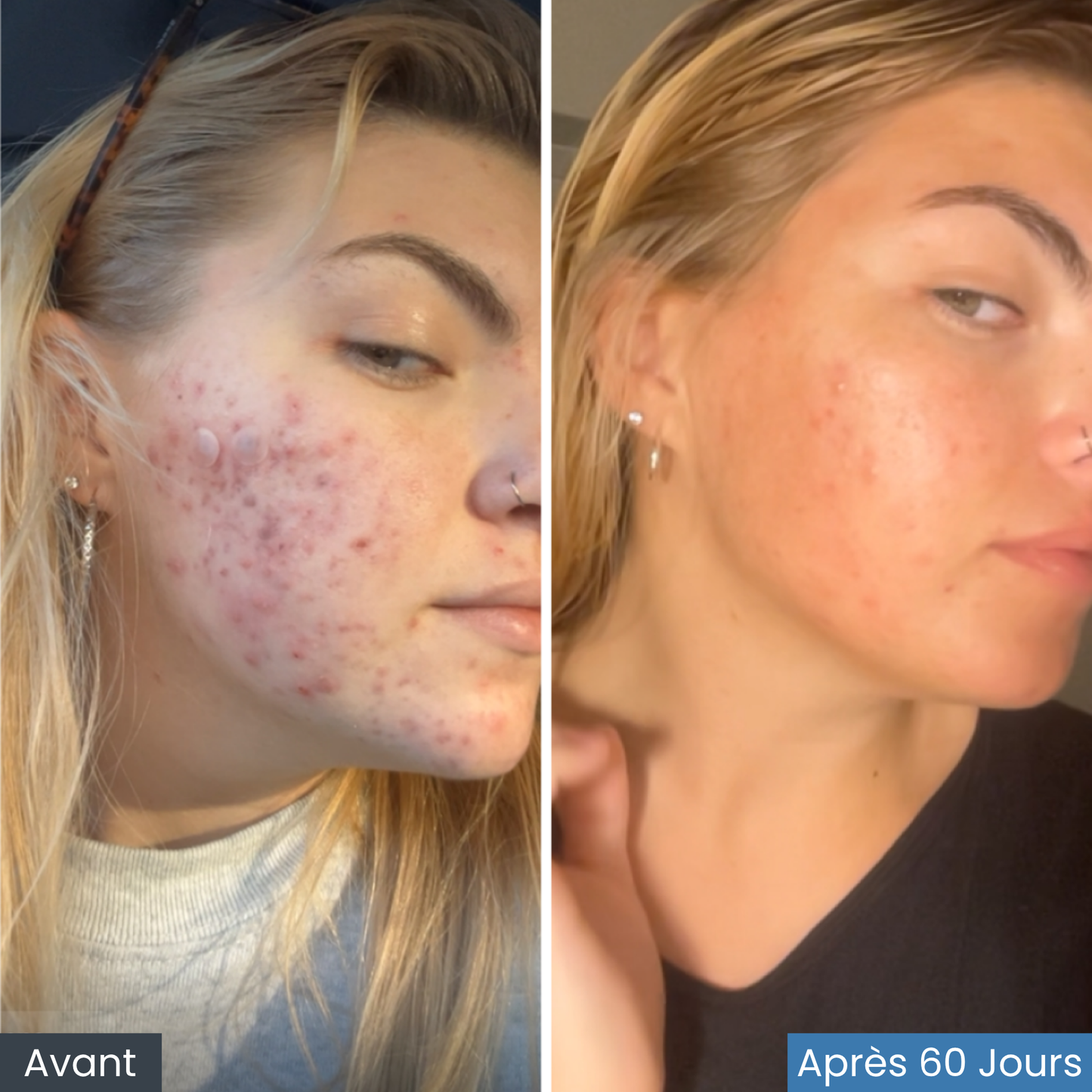 Rituel anti-acné et anti-rougeurs