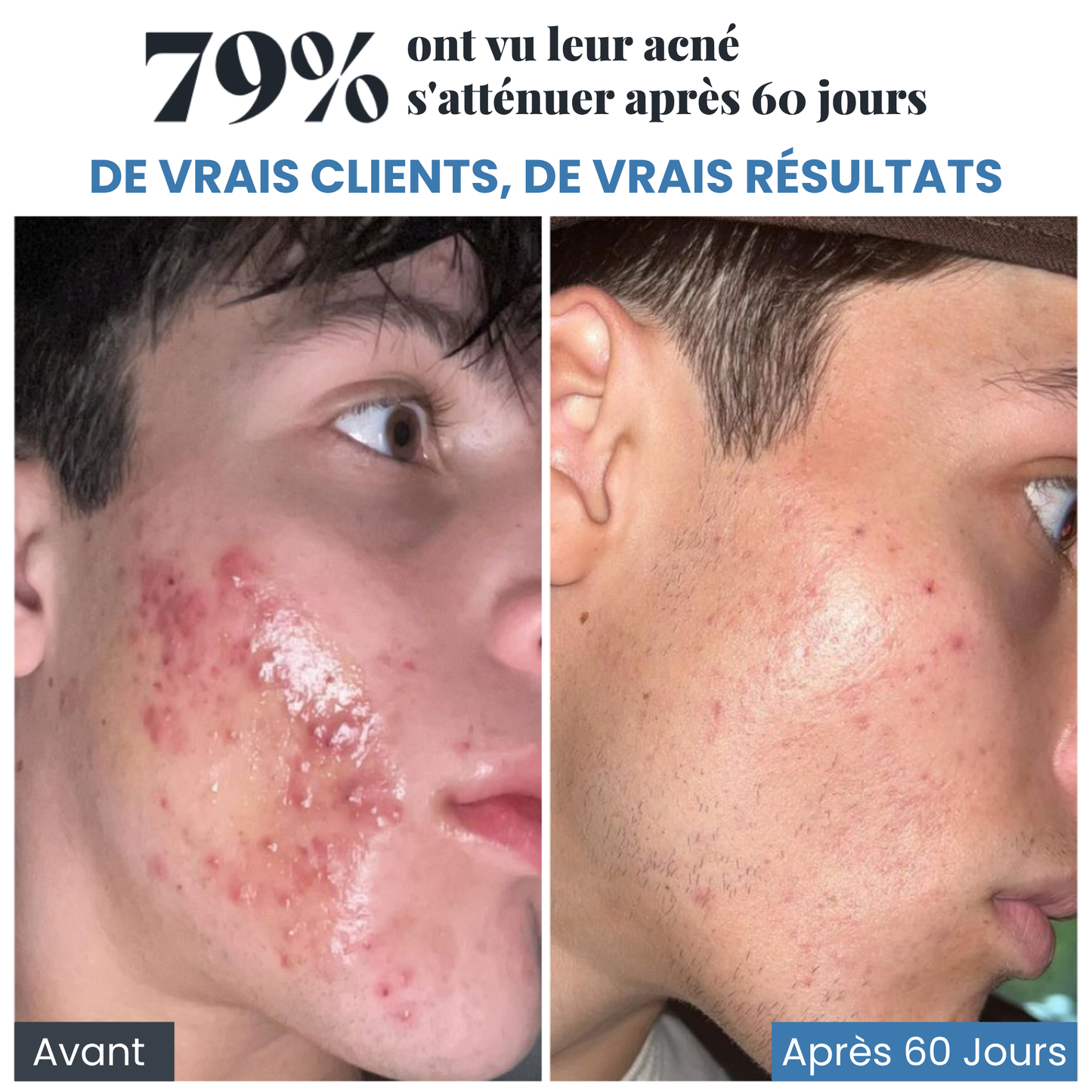 Rituel anti-acné et anti-rougeurs